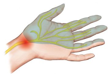 متلازمة النفق الرسغي – Carpal tunnel syndrome